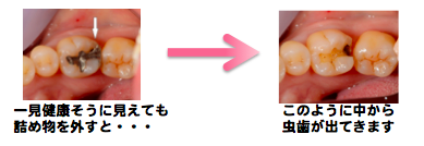 二次虫歯